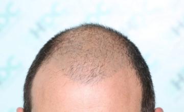 NW Class 5 patient with 7370 FUE grafts in two sessions – Dr Maras – HDC Hair Clinic