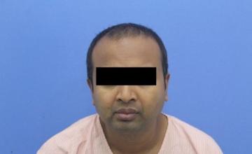 Dr. Kapil Dua – 2270 Grafts Bio FUE Hair Transplant Result | NH Grade III Result