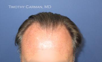 Dr Timothy Carman 1936 FU Strip Excision Surgery. La Jolla Hair Restoration Medical Center.