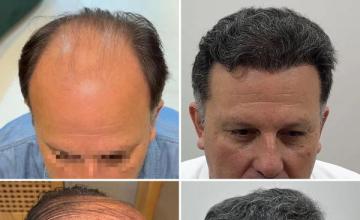 13k grafts, 2 days, Dr. Pittella.