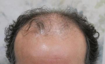 DR Carman 2715 FU 5 Month Result