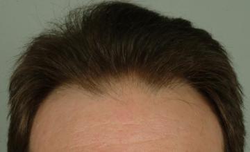 2156 Grafts/4208 Hairs, 1 session FUT- Robert Haber, MD