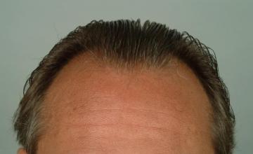 2558 Grafts/5495 Hairs, 1 session FUT- Robert Haber, MD