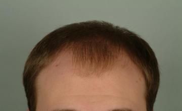 6 month results, one session, 1968 grafts/4183 hairs FUT- Robert Haber, MD