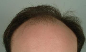 6 month results, one session, 3052 grafts/5707hairs FUT- Robert Haber, MD