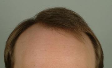 6 month results, one session, 2263 grafts/4350 hairs FUT- Robert Haber, MD