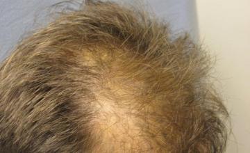 Hair transplant by Dr. Rose