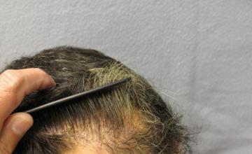Hair transplant by DR. Nusbaum and Dr. Rose