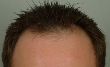 12 month results, one session, 1993 grafts/3489 hairs FUT- Robert Haber, MD