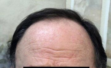 Dr. Timothy Carman- 2424 FU grafts; 5 months PostOp