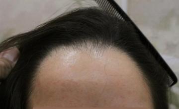 Dr. Timothy Carman- Female Hairline Lowering Procedure; 7 Days Post Op