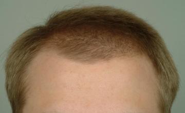 7 year followup one session on very young patient. 582 grafts/1173 hairs.