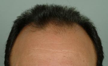 6 month results, one session, 3292 grafts/6600 hairs FUT- Robert Haber, MD