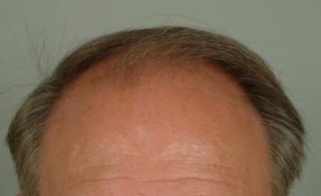 1 year followup, one session, 2898 grafts/5460 hairs FUT- Robert Haber, MD