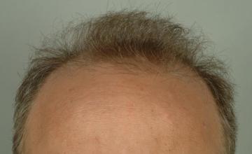 2 year followup, one session, 3019 grafts, 6033 hairs FUT- Robert Haber, MD