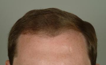1 year followup, one session, 2779 grafts/4949 hairs FUT- Robert Haber, MD