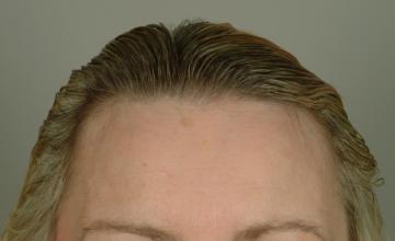 Female case, 6 month results, one session, 1650 3580 hairs FUT- Robert Haber, MD