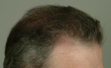 1 year followup, one session, 3115 grafts/6278 hairs FUT- Robert Haber, MD