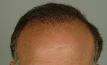 1 year followup, one session, 2548 grafts/5204 hairs FUT- Robert Haber, MD