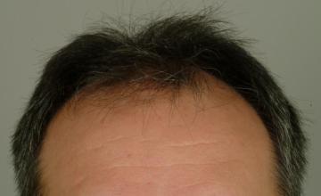 1 year followup, one session, 2744 grafts/5584hairs FUT- Robert Haber, MD