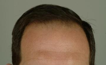 6 month results, one session, 2808 grafts/5794 hairs FUT- Robert Haber, MD