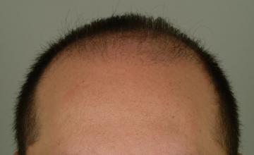6 month results, one session, 2806 grafts/5409 hairs FUT- Robert Haber, MD
