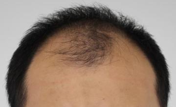 Dr. Rahal / 3016 graft FUE / NW 5 / 14 months post-op