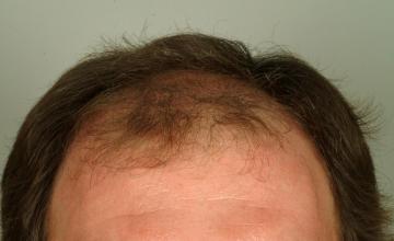 1 year followup, one session, 2895 grafts/5949 hairs FUT- Robert Haber, MD