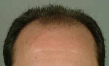 1 year followup, one session, 2185 grafts/4299 hairs FUT- Robert Haber, MD