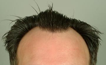 1 year followup, two sessions, 5234 grafts FUT- Robert Haber, MD