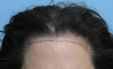 58 Year Old Female with an Elevated Hair Line by Dr. Parsa Mohebi