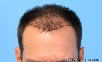 51 Year Old Male with Class III-V Hair Loss by Dr. Parsa Mohebi