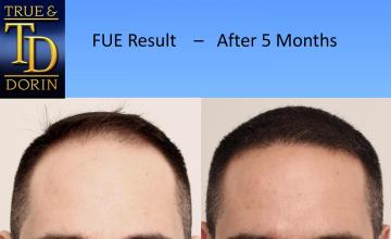 Dr. Robert Dorin -  Before and After FUE - 5 months