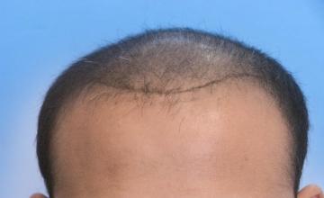 33 Year Old Male with Class VI Hair Loss by Dr. Parsa Mohebi