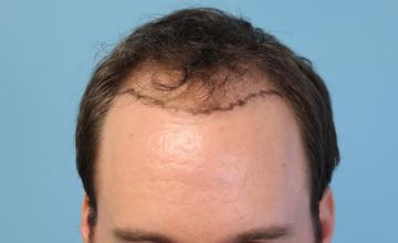 25 Year Old Male with Class III-V Hair Loss by Dr. Parsa Mohebi