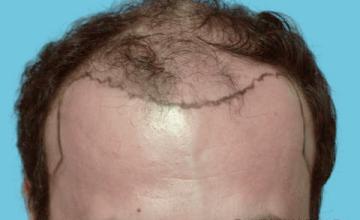 39 Year Old Male with Class VI Hair Loss by Dr. Parsa Mohebi