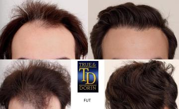 Dr. Dorin ( True &amp; Dorin Medical ) - Frontal restoration