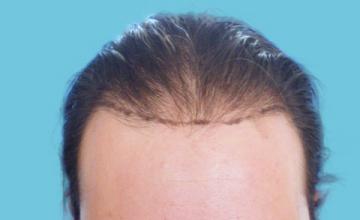 38 Year Old Male with Top Thinning Hair Loss by Dr. Parsa Mohebi