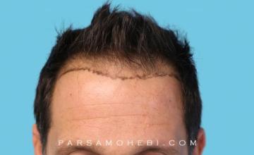 44 Year Old Male with Class III-V Hair Loss by Dr. Parsa Mohebi