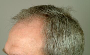 6 month results, one session, 2915 grafts/6223 hairs FUT- Robert Haber, MD