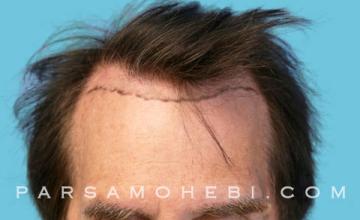 66 Year Old Male with Class IV Hair Loss by Dr. Parsa Mohebi