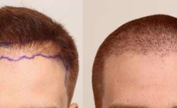 DR. DORIN - Buzz cut FUE  - 1500 grafts