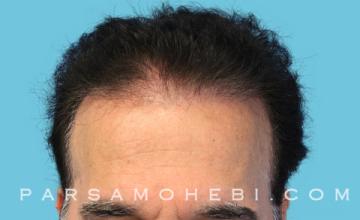 56 Year Old Male with III-V Hair Loss by Dr. Parsa Mohebi