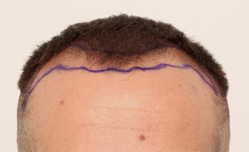 Dr. DORIN - Frontal FUE - 11 months