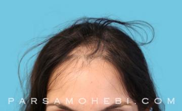 39 Year Old Female with Male Pattern Baldness by Dr. Parsa Mohebi