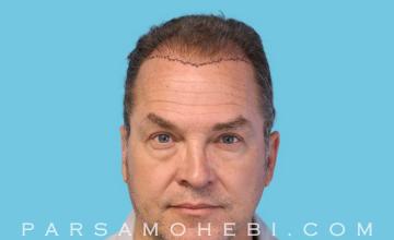 54 Year Old Male with Class III Hair Loss by Dr. Parsa Mohebi