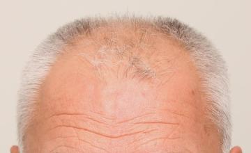 Dr. DORIN - FUT  - 2639 Grafts / NW 5A