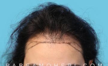 29 Year Old Female with Female Pattern Baldness by Dr. Parsa Mohebi