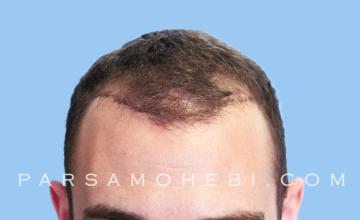 25 Year Old Male with Class III Hair Loss by Dr. Parsa Mohebi