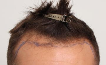 DR. DORIN - 3329 Grafts FUT - Hairline Restoration